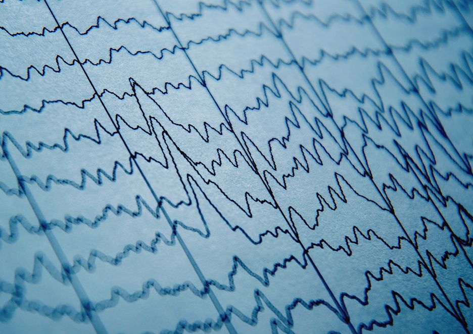 Sindrome di Lennox Gastaut diagnosi