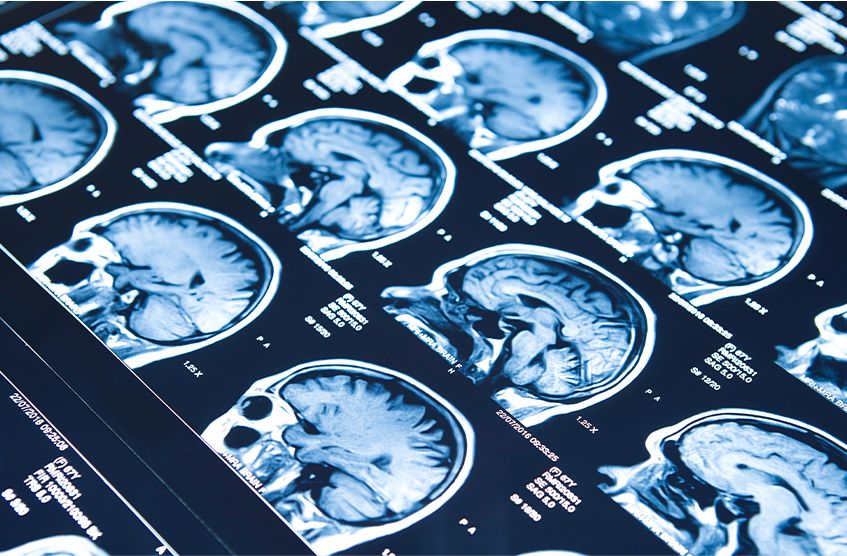 Pipeline e studi clinici Neurologia