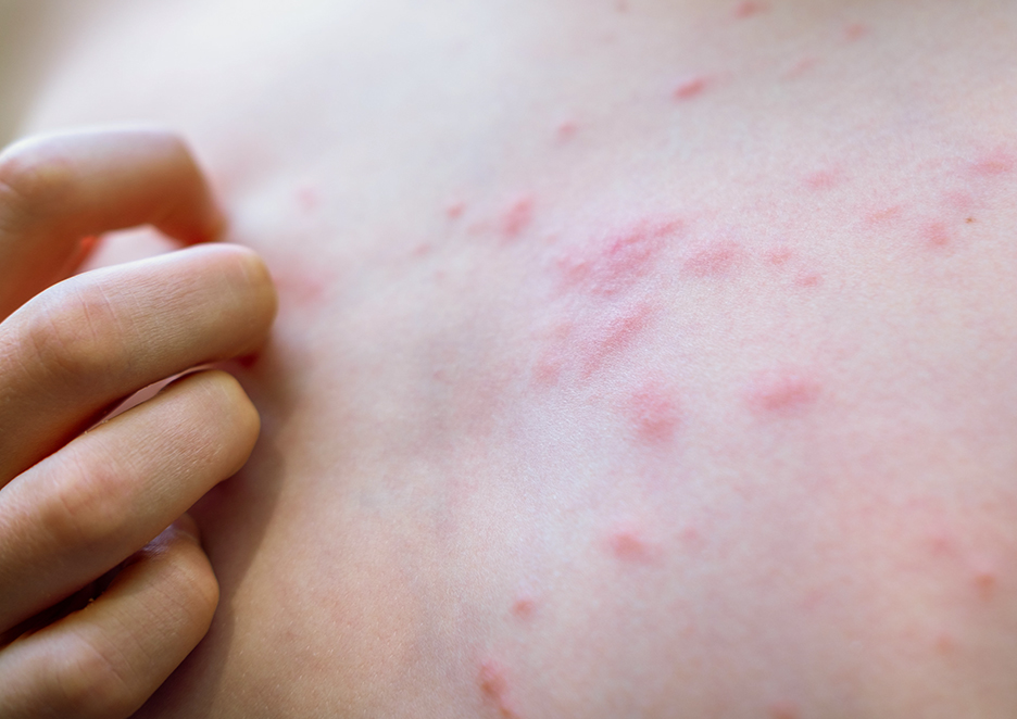 Orticaria cos'è